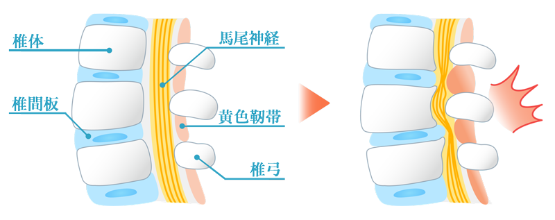 脊柱管狭窄症